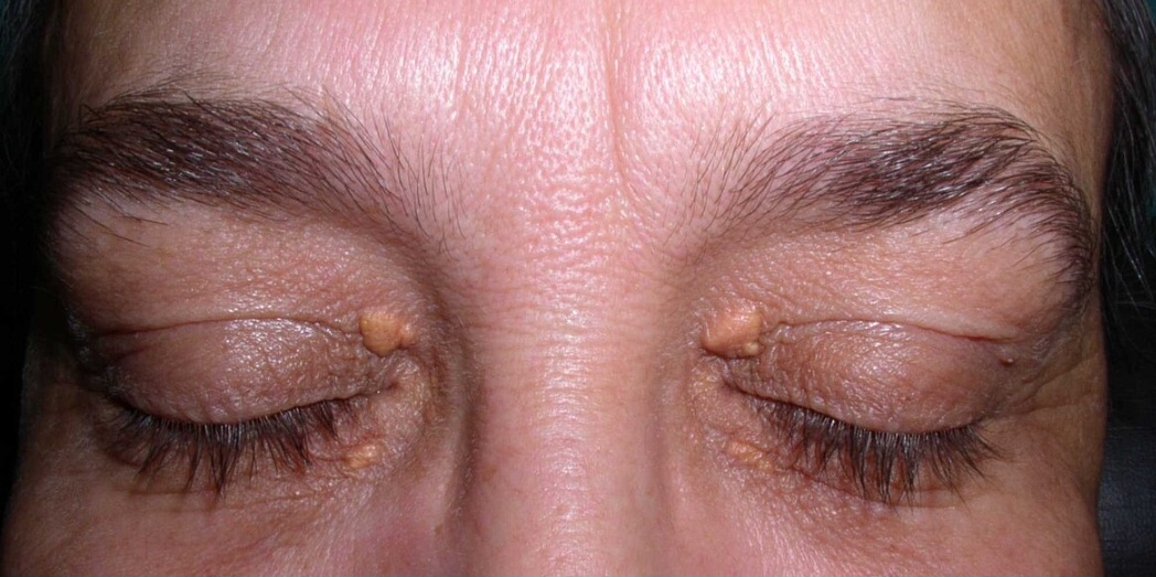 Skin tag removal Milton Keynes