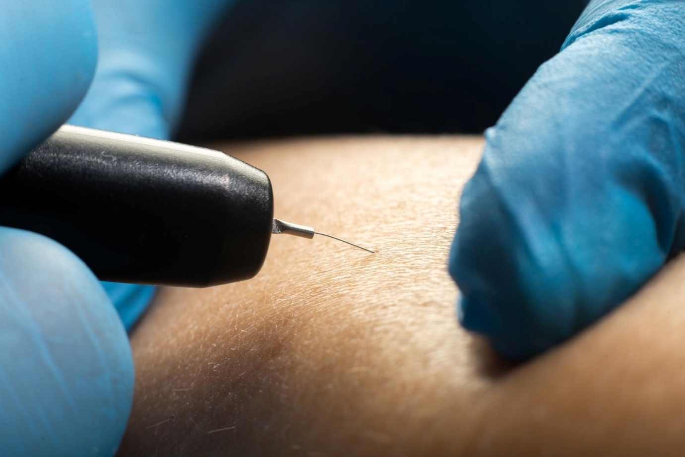 Electrolysis for Different Skin and Hair Types