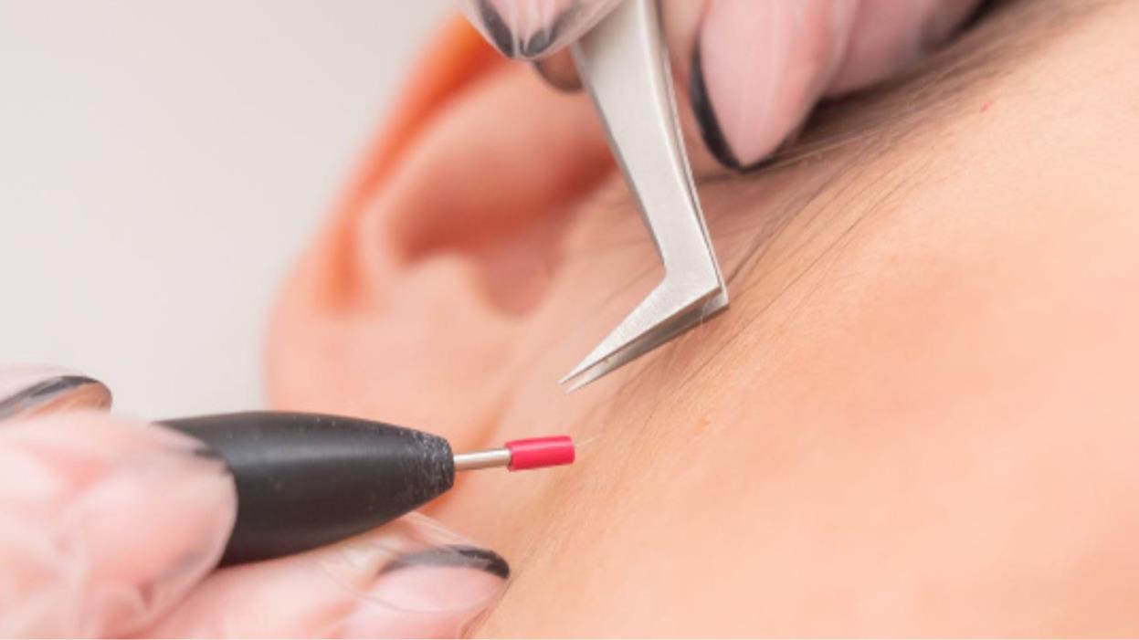 Electrolysis vs Laser Hair Removal