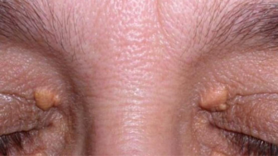 how professional Xanthelasma removal ensures safer results
