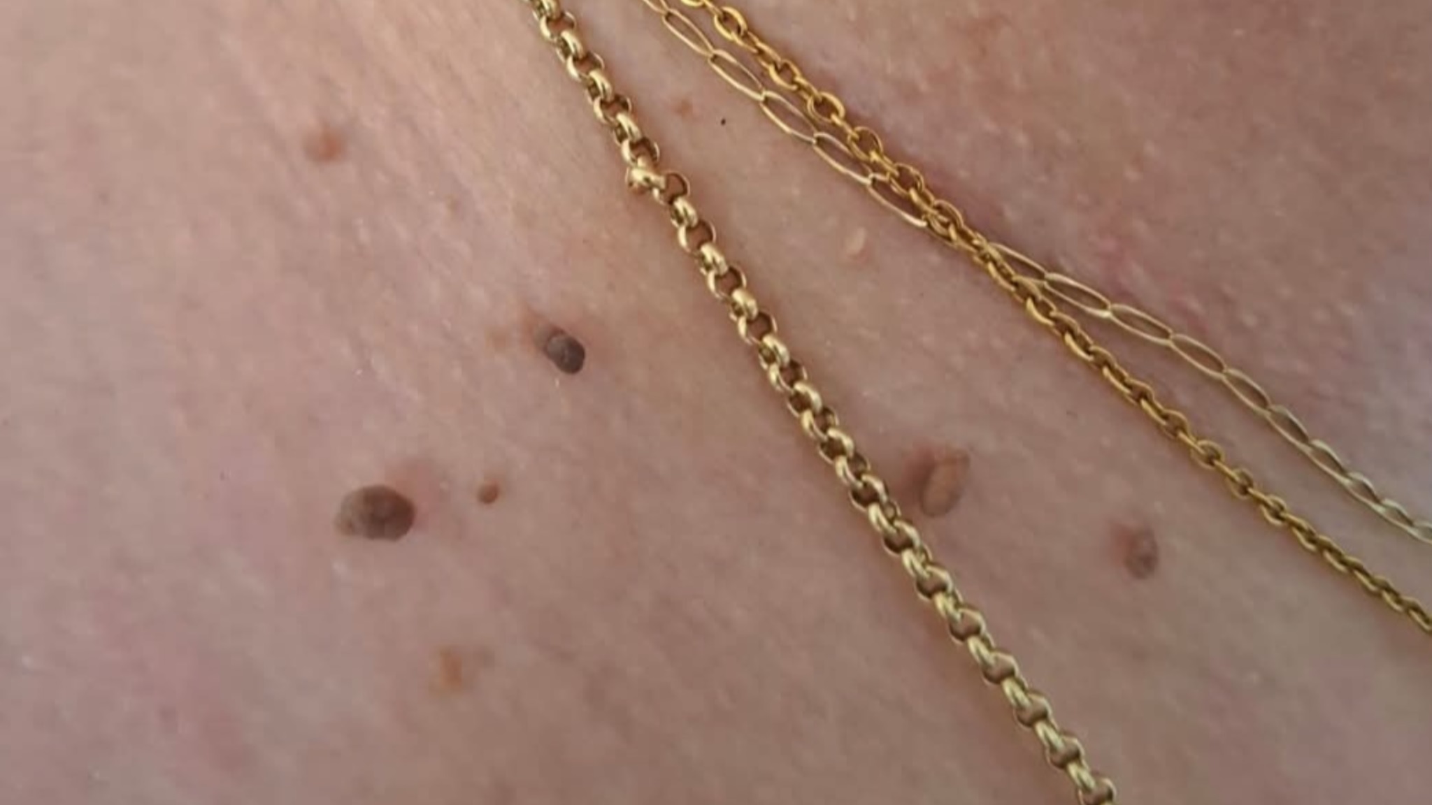 types of skin growth