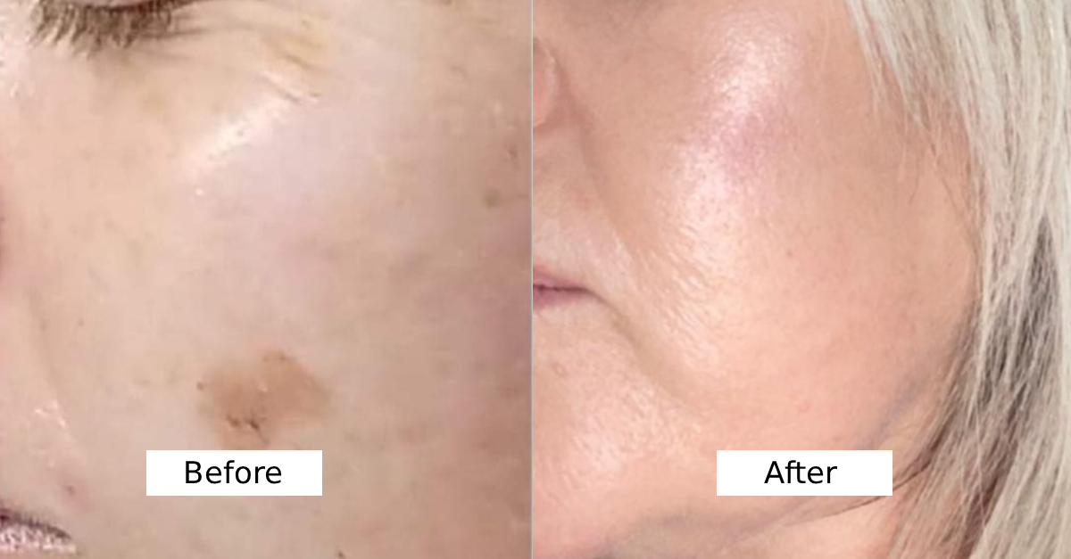 Age Spot Removal difference
