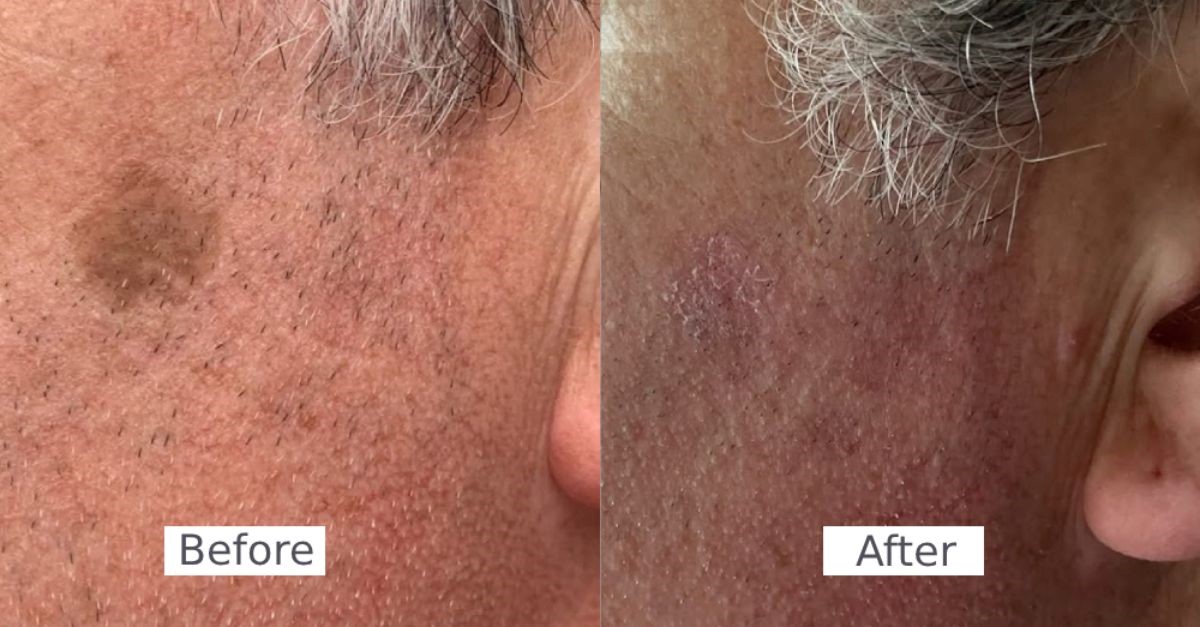 Age Spot Removal difference