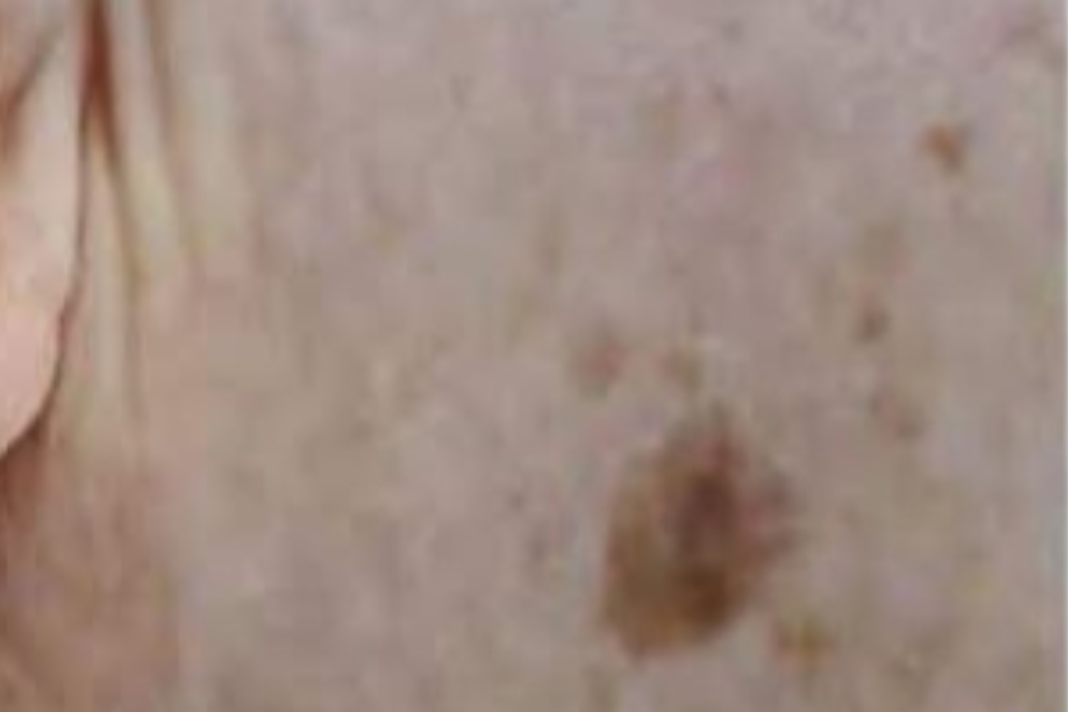 Age spots replacement