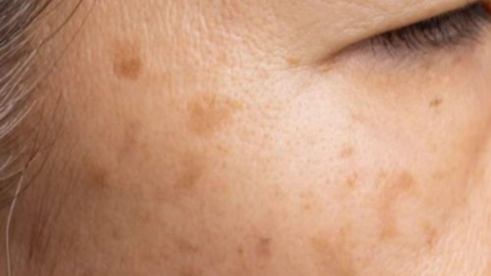 Remove Age Spots on the Face