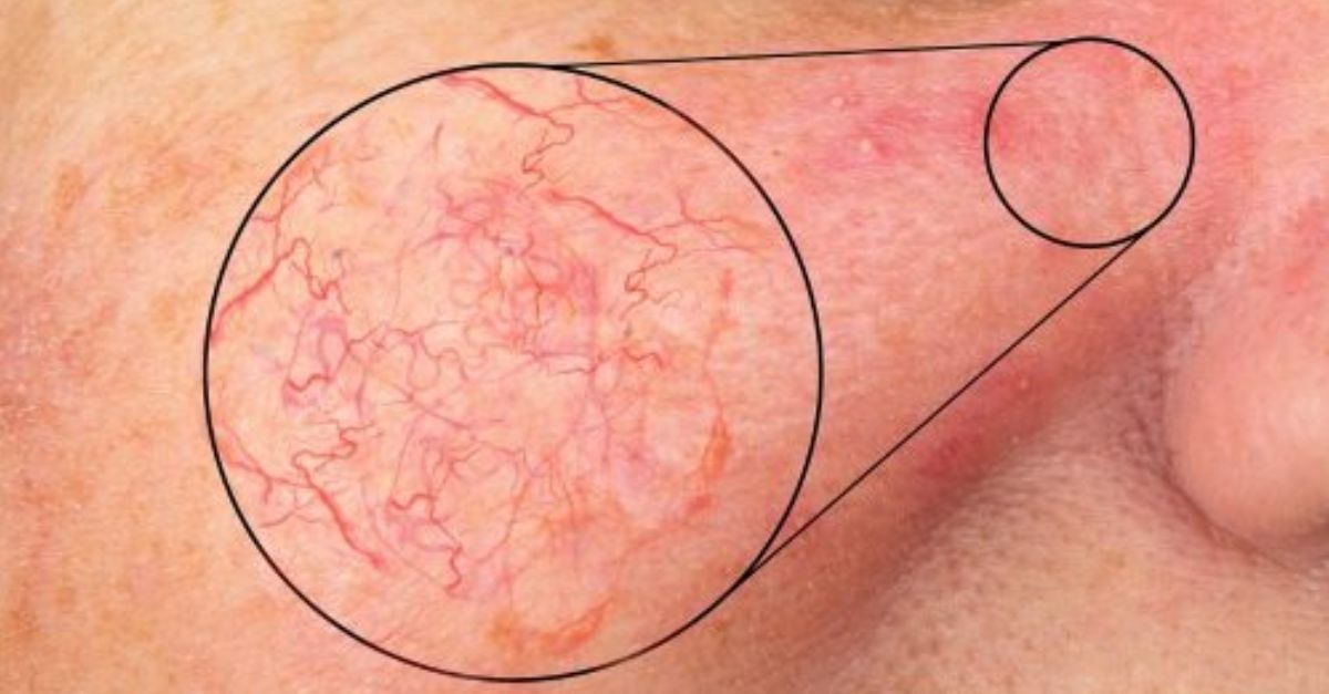 What Are Broken Capillaries