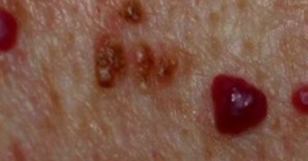 Cherry Angioma