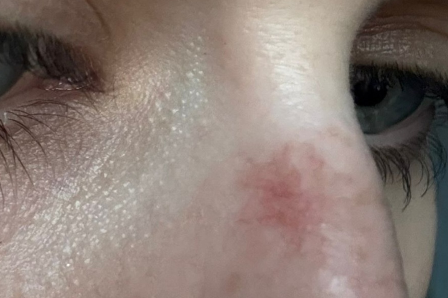 Broken Capillary Removal & Spider Naevi Removal-2
