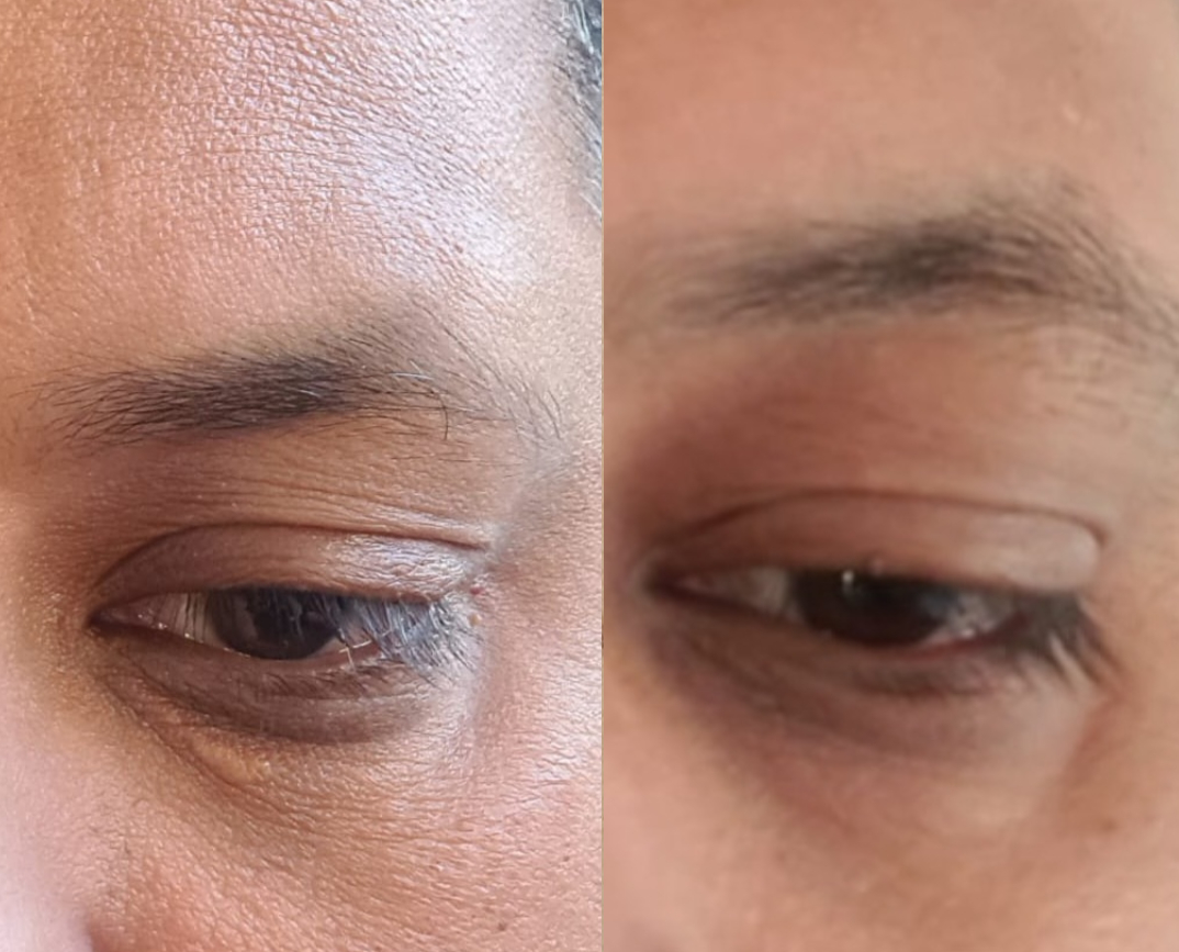 Xanthelasma Removal