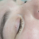milia removal