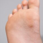 Warts/Verruca’s Removal