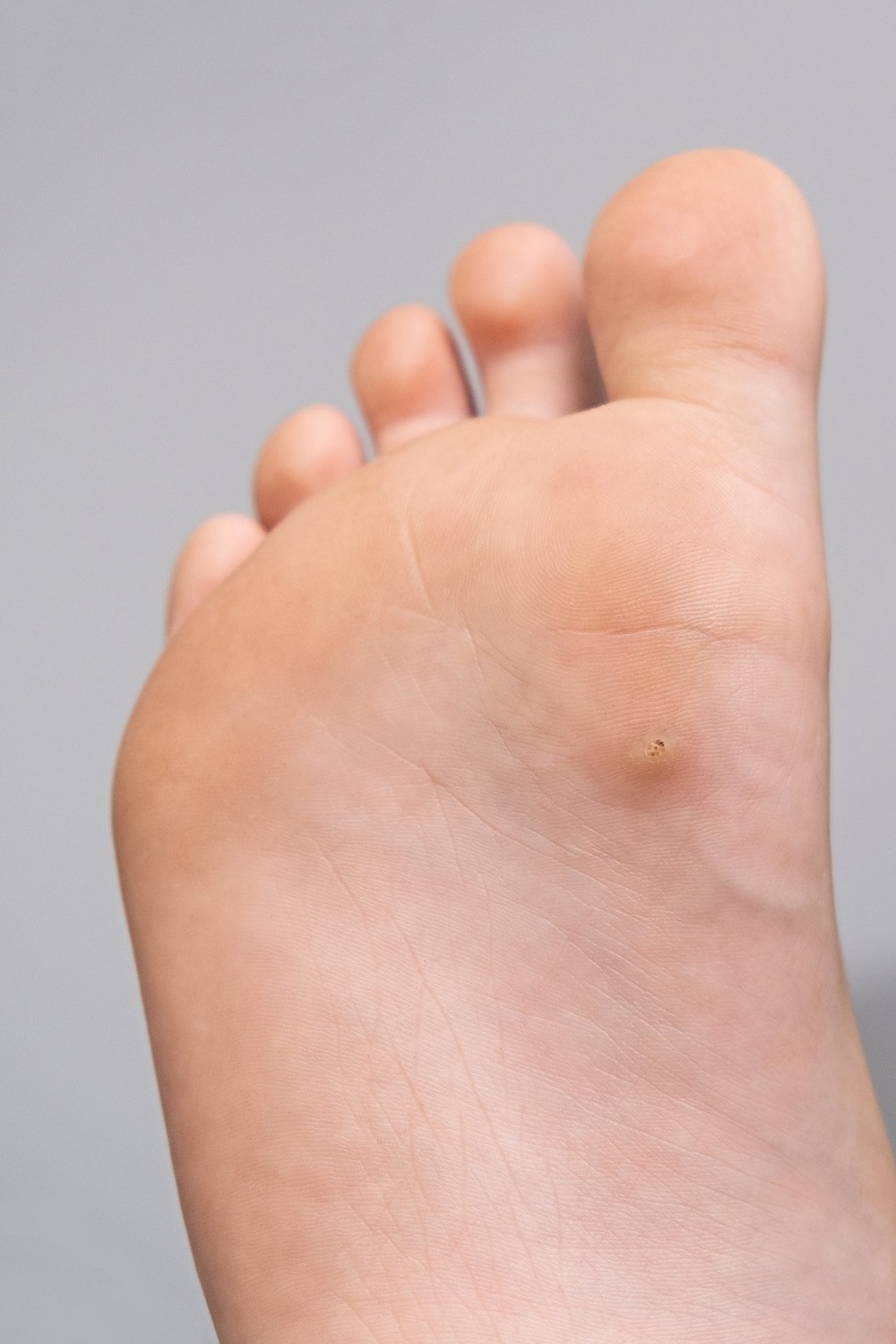 Warts/Verruca’s Removal