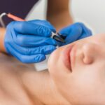 Electroepilation treatment