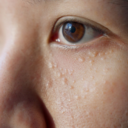 syringoma
