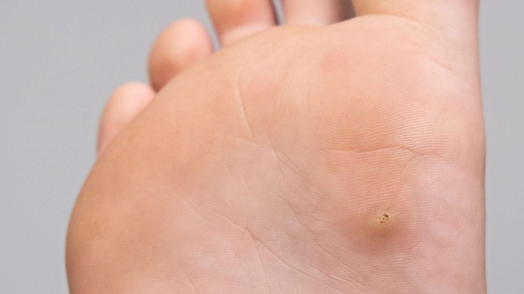 Wart Removal with Advanced Electrolysis