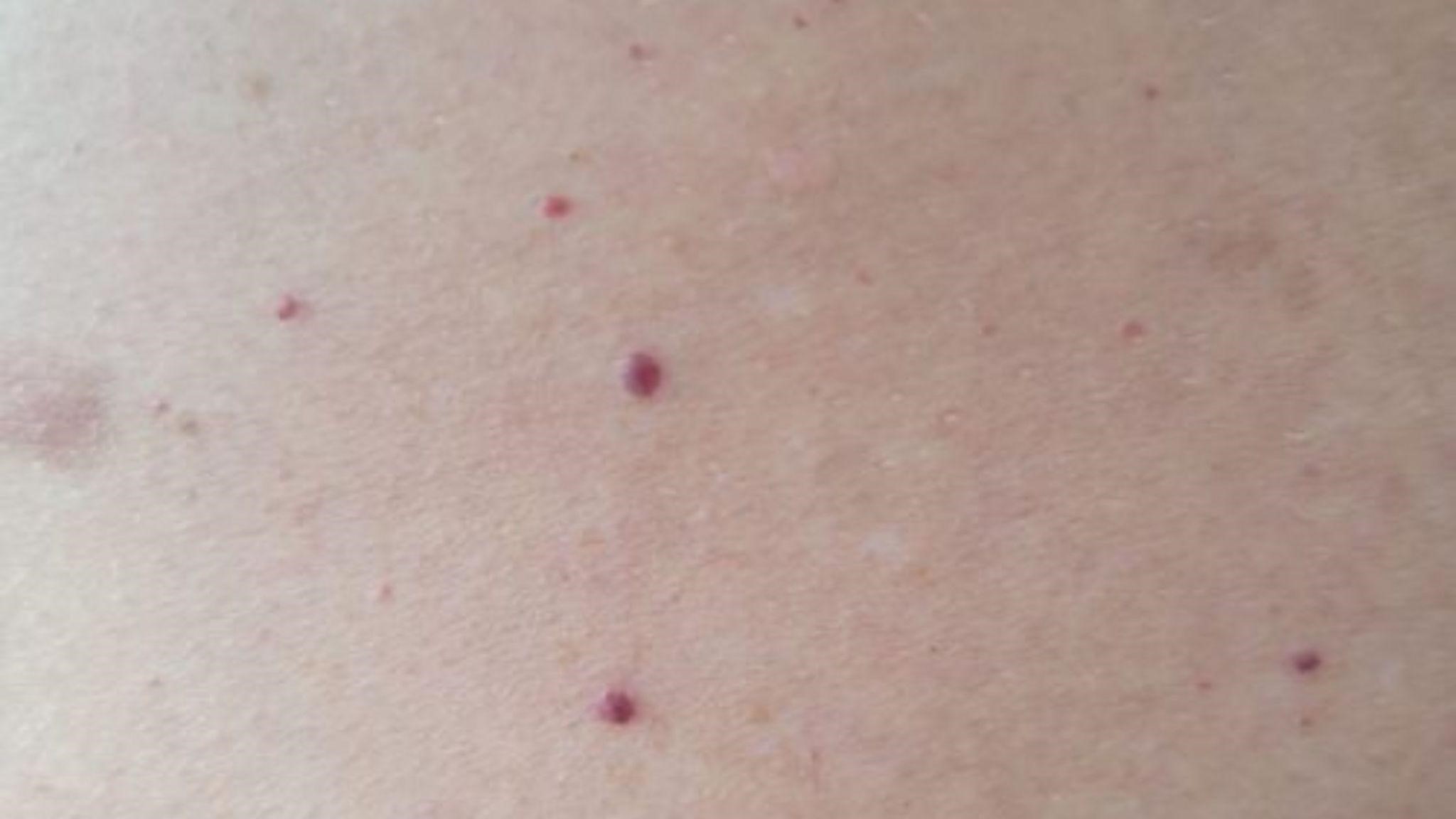 cherry angioma removal cost
