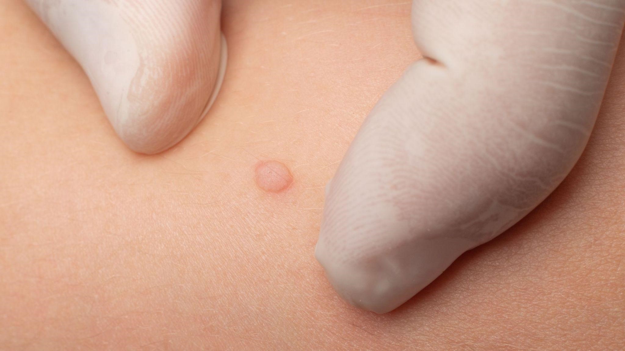 Fibrous Papule treatment