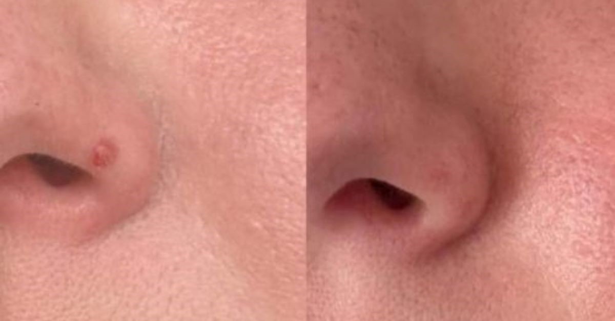 Fibrous papule removal