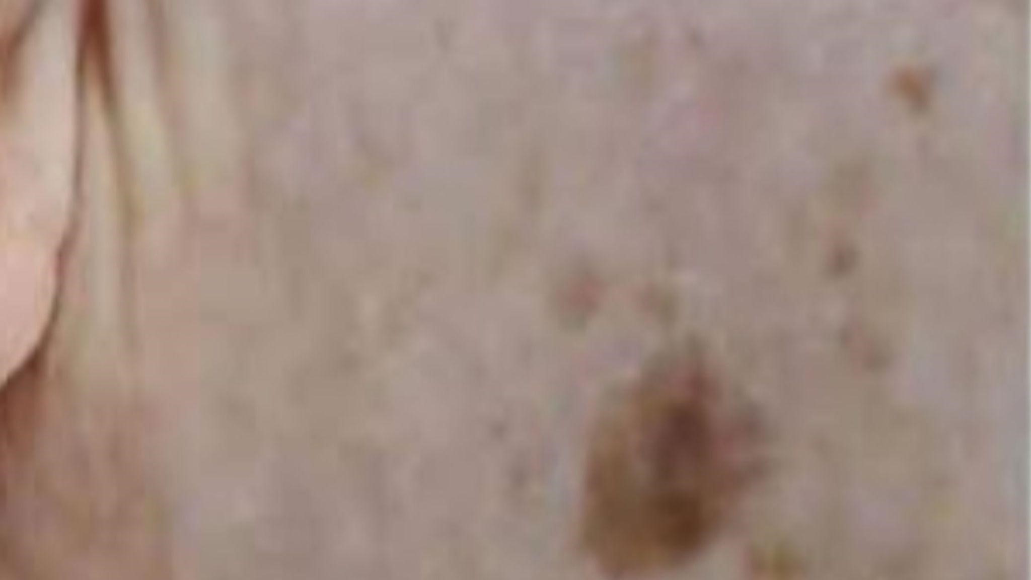how much does age spots removal cost