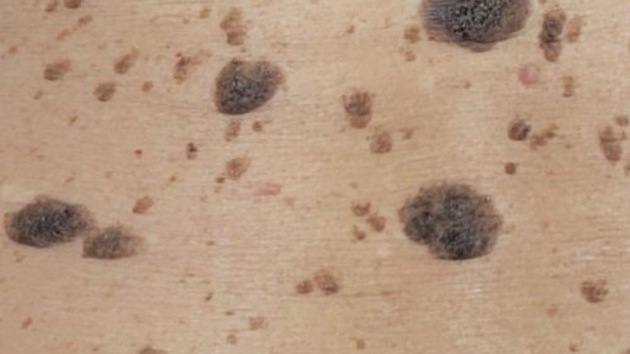 seborrheic keratosis removal