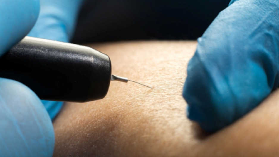 Hair Removal Electrolysis Sessions