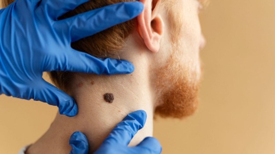 Seborrheic Keratosis Treatment