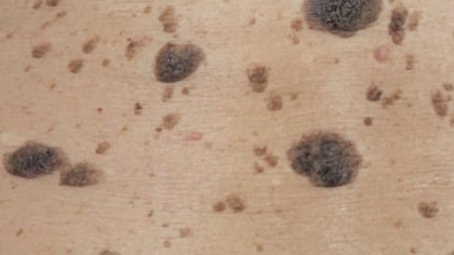 Seborrheic Keratosis
