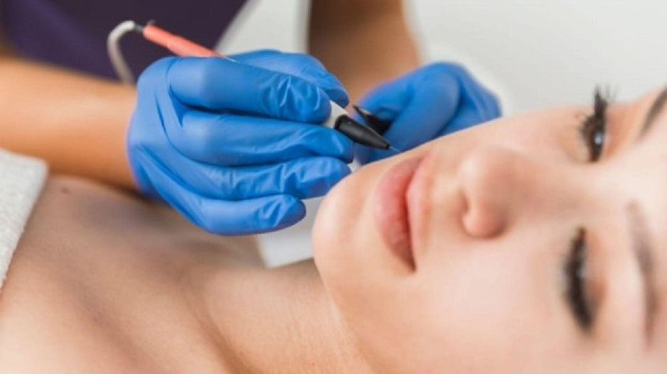 electrolysis hair removal