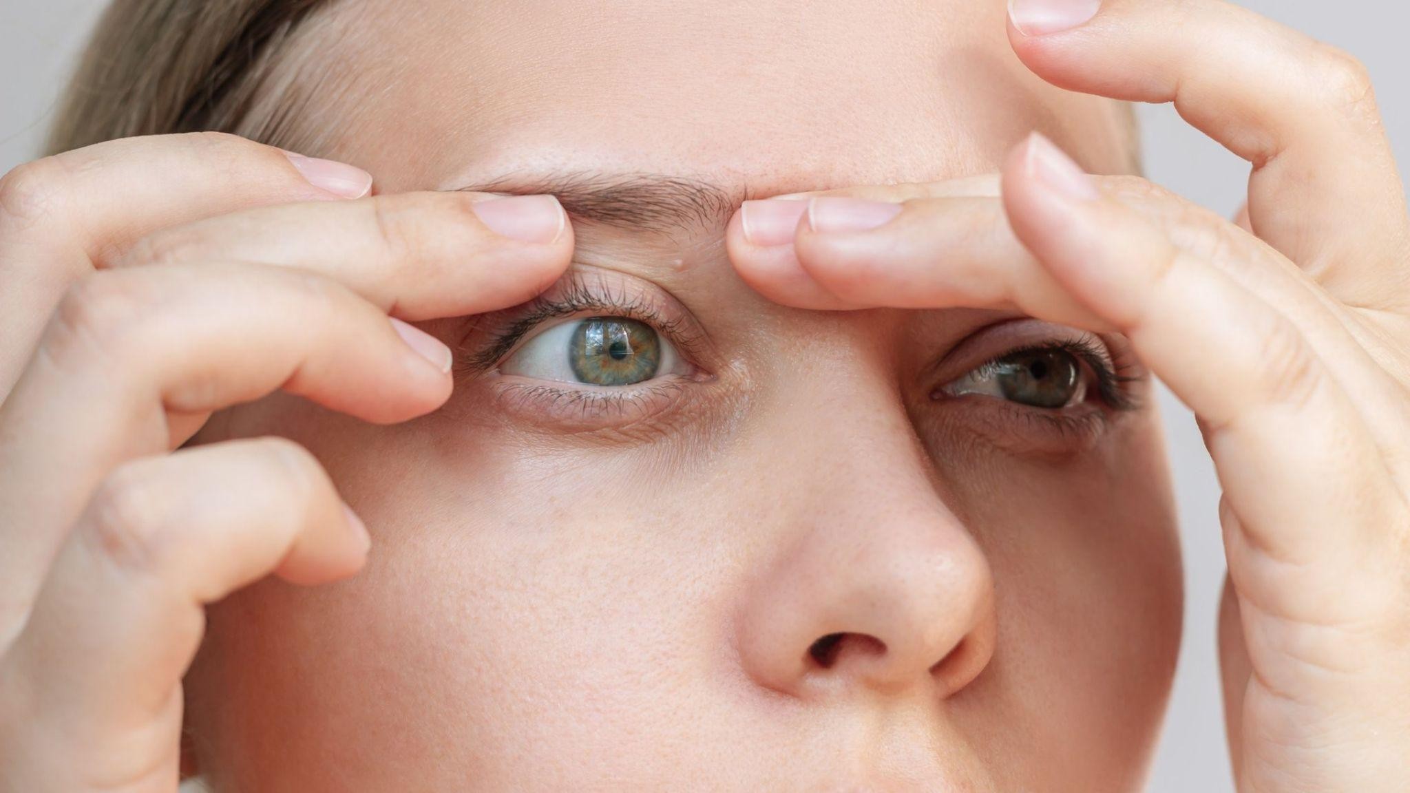Milia on Cheeks and Eyelids