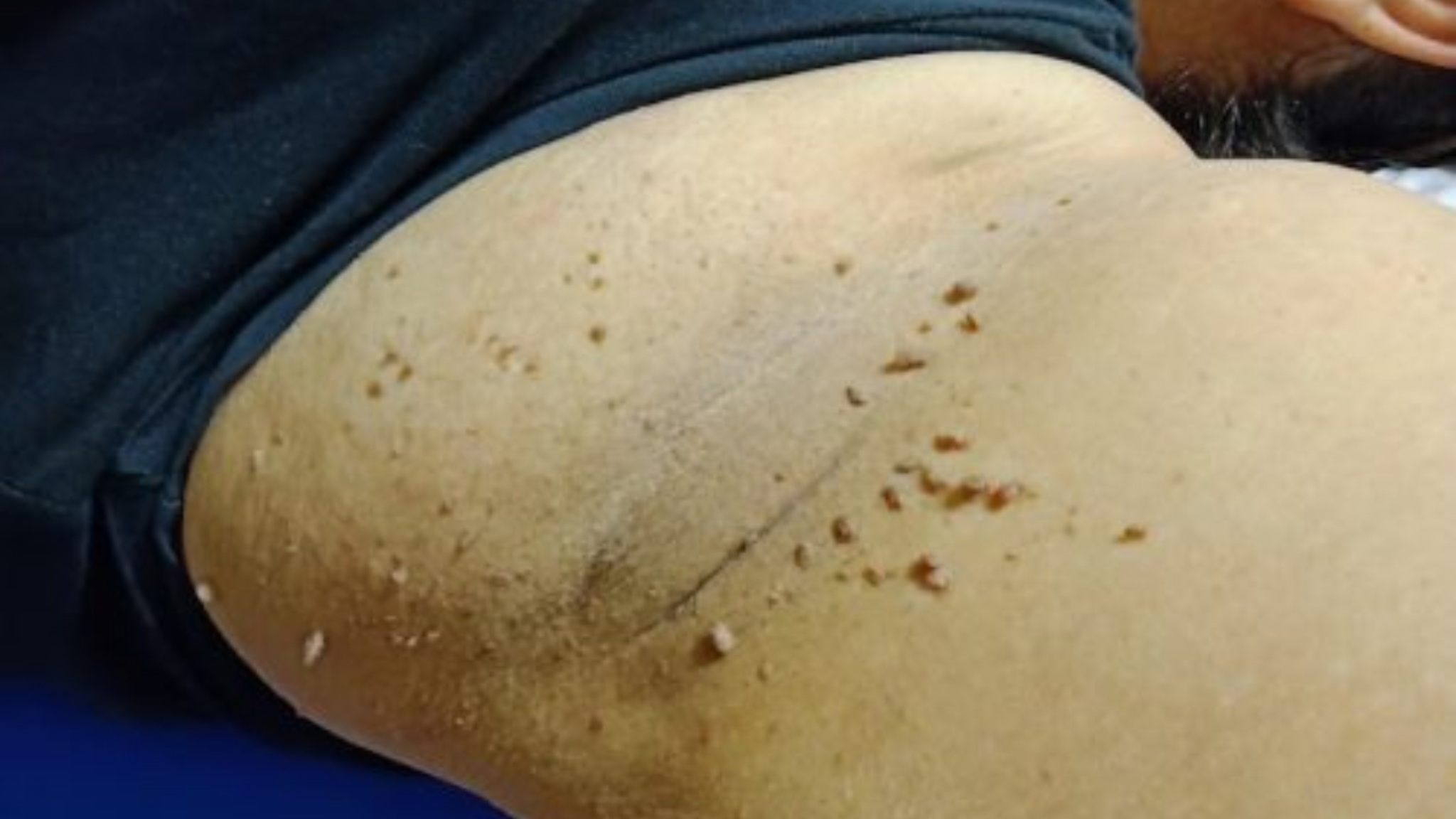 Wart Removal Treatment2