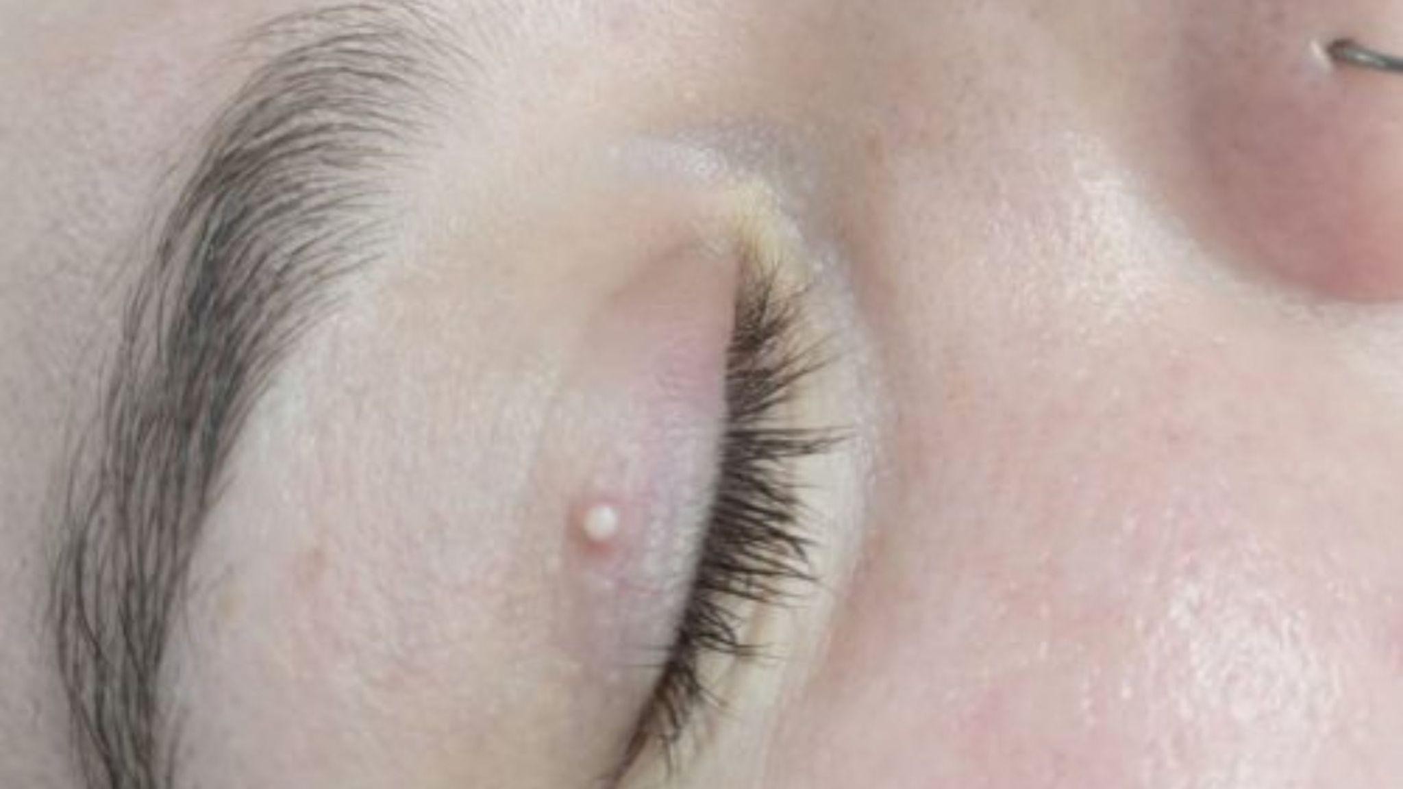 milia removal