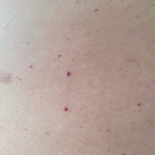 Blood spot replacement