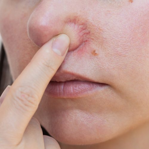 Broken Capillary Removal & Spider Naevi Removal-2