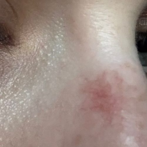 Broken Capillary Removal & Spider Naevi Removal-2