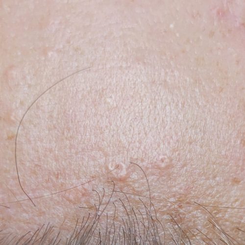 Sebaceous-Hyperplasia3