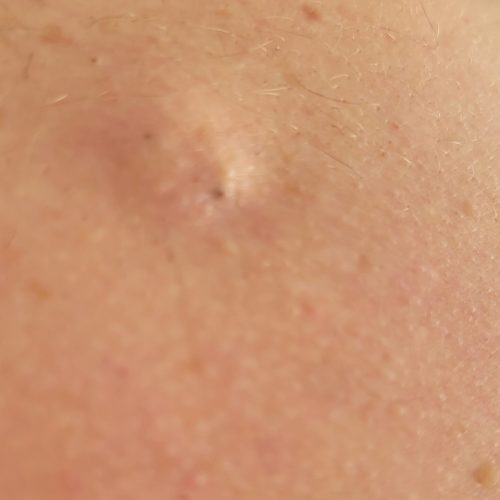 Sebaceous cyst