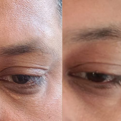 Xanthelasma Removal