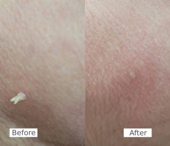 filiform wart removal