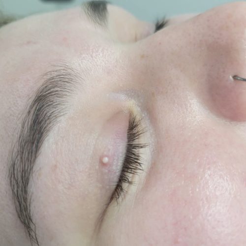 milia removal